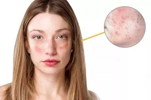 春季過敏不止你一個 預(yù)防要專業(yè)! 春季過敏不止你一個 預(yù)防要專業(yè)!